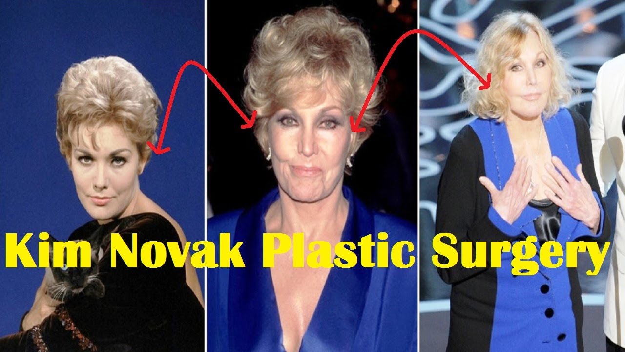 Kim Novak Plastic Surgery Gone Wrong | Before and After