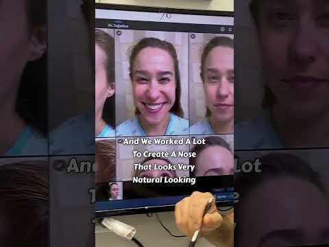 Video thumbnail: Intra Operation Analysis! | wide Nose | Bulbous, Asymmetric Nose Correction! · Ali Sajjadian