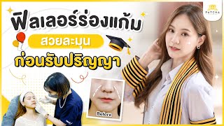 รีวิวฟิลเลอร์ร่องแก้ม แก้ปัญหาร่องแก้มเยอะ ให้ใบหน้าดูอ่อนเยาว์