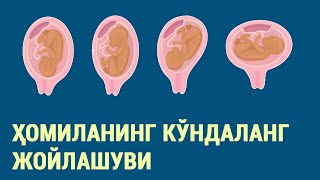 картинка: Ҳомиланинг кўндаланг жойлашуви
