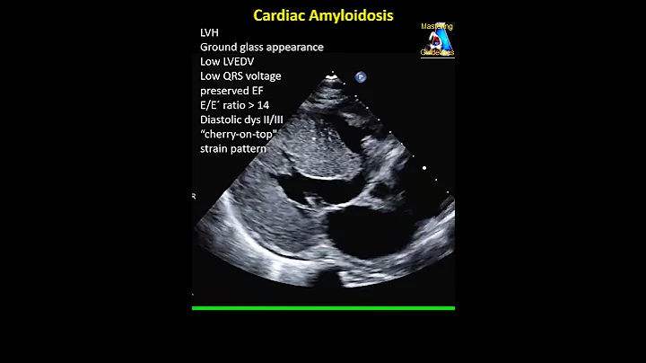 Cardiac Amyloidosis
