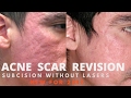 How to treat acne scars- 2018 guide by Dermatologist