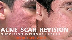 How to treat acne scars- 2018 guide by Dermatologist