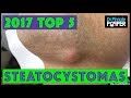 Dr Pimple Popper's Top 5 Steatocystoma POPS for 2017