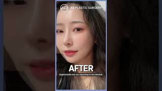 [Plastic Surgery in Korea] Face contour surgery and Perfect V-line #shorts