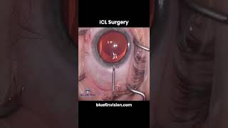 Inside ICL Surgery at Blue Fin Vision® #iclsurgery