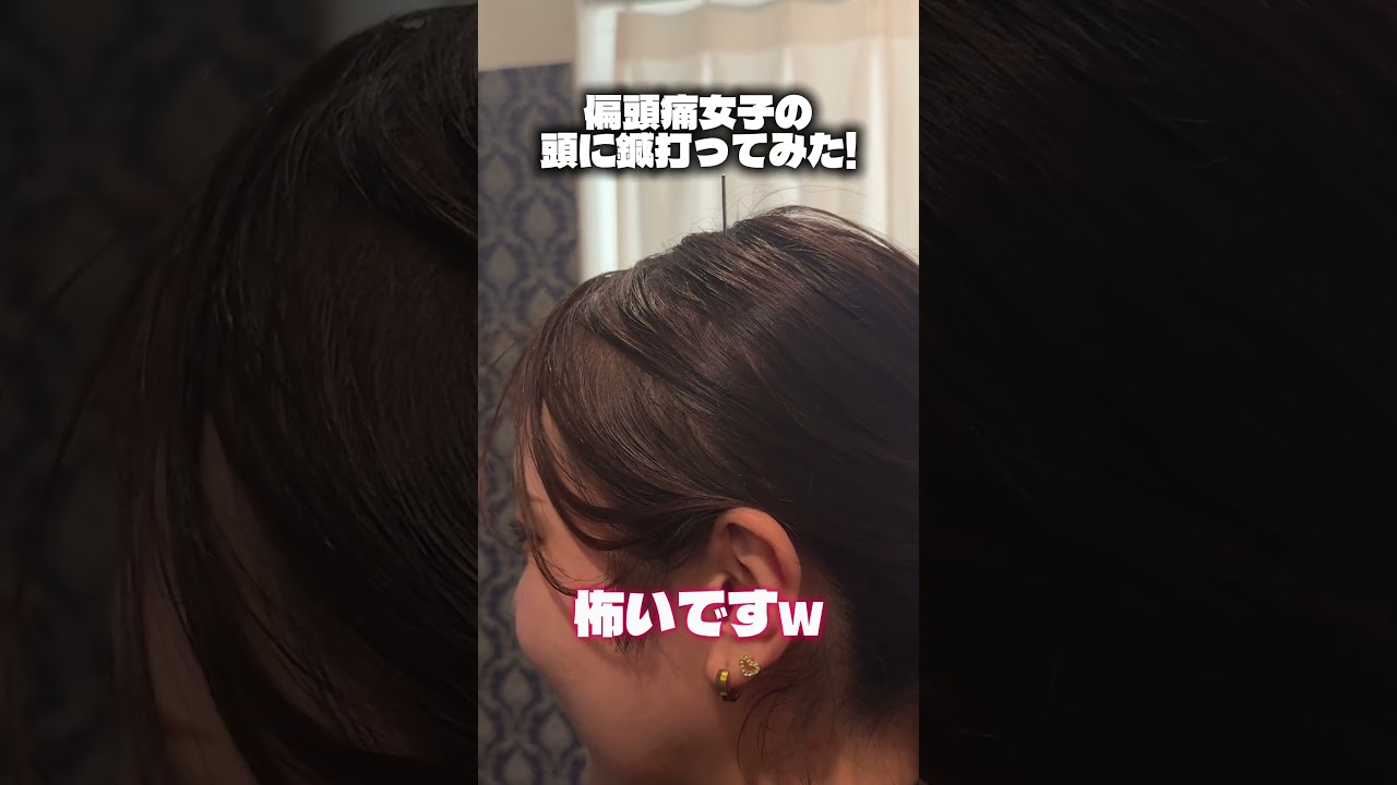 偏頭痛持ちの頭蓋骨に鍼で一撃!