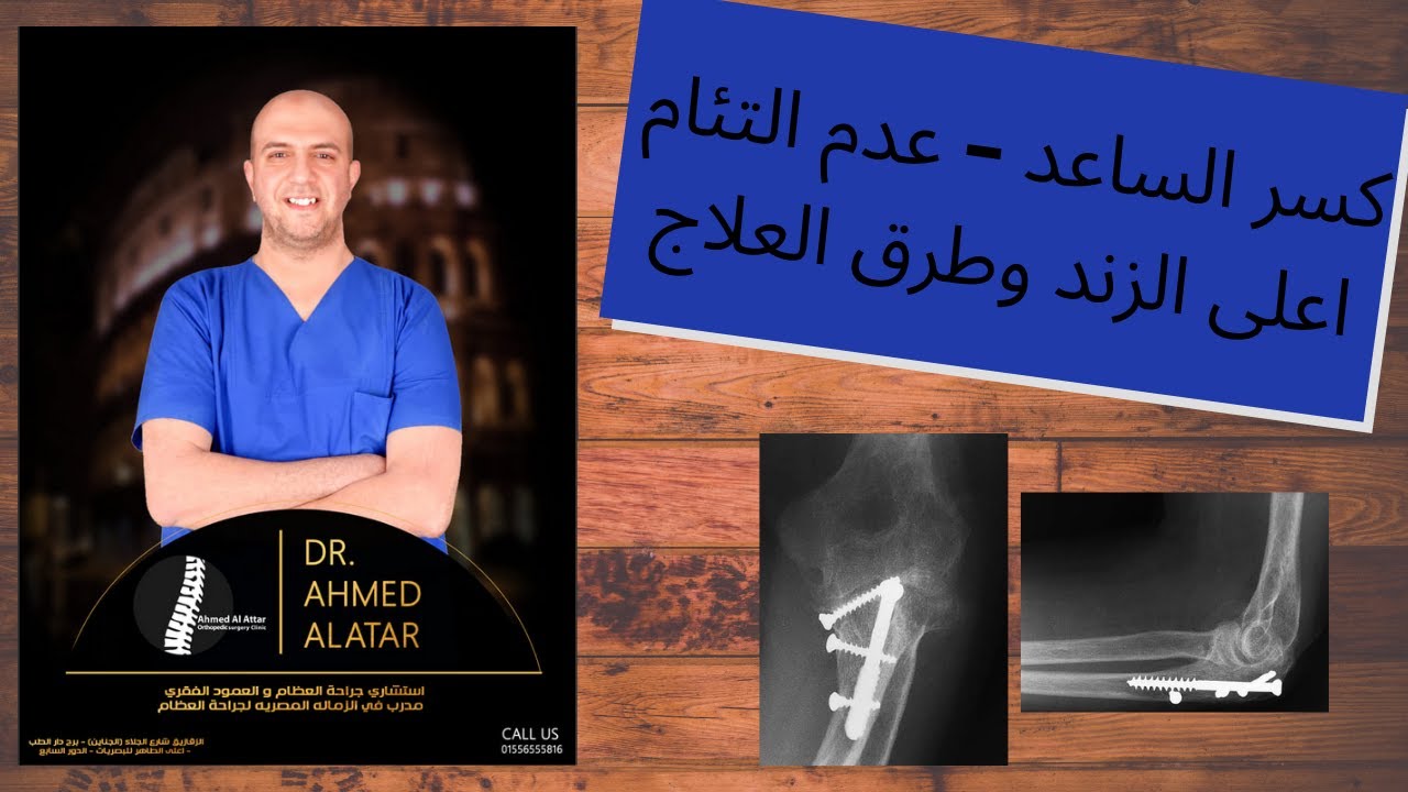 كسر الساعد عدم التئام اعلى الزند وطرق العلاج Youtube