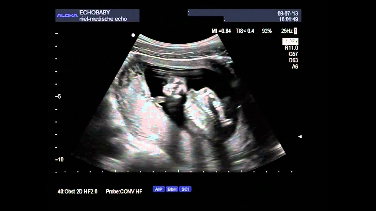 Echo 14 Weken Zwanger Jongen Met Ingesproken Uitleg YouTube echo-14-weken-zwanger-jongen-met-ingesproken-uitleg-youtube