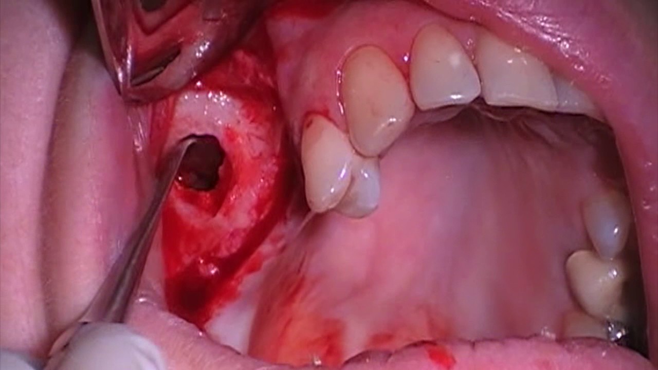 Elevación seno - YouTube