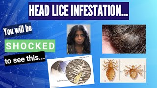 Head lice infestation...shocking to see this @DrArifMDDermatologist #Head lice