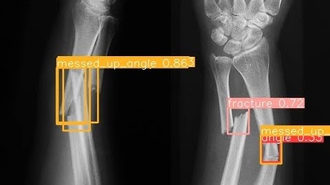 Bone Fracture Detection YoloV8| Computer Vision| Yolo| Ultralytics| Roboflow|Project