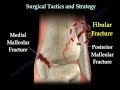 Ankle  fracture / Fractures and its repair- Everything You Need To Know - Dr. Nabil Ebraheim