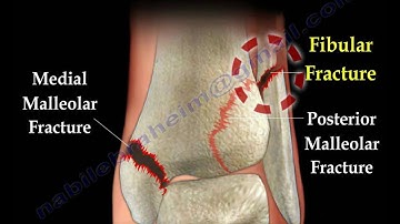 Ankle  fracture / Fractures and its repair- Everything You Need To Know - Dr. Nabil Ebraheim