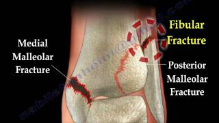 Ankle  fracture / Fractures and its repair- Everything You Need To Know - Dr. Nabil Ebraheim