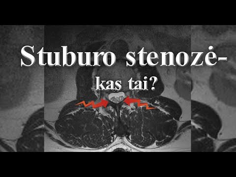 Stuburo stenozė  kas tai?