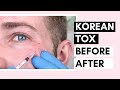 Korean Botulinum Toxin Before & After | How To Dilute Toxins And Use For Forehead And Crow’s Feet