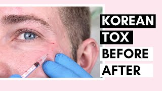 Korean Botulinum Toxin Before & After | How To Dilute Toxins And Use For Forehead And Crow’s Feet by Viana Care 40,085 views 3 years ago 19 minutes