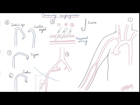 Radial and femoral access for coronary angiogram