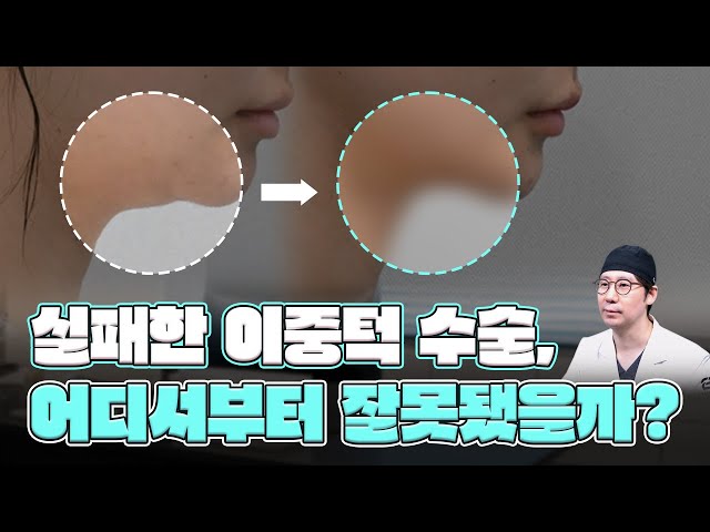 실패한 이중턱 수술, 어디서부터 잘못됐을까?