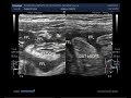 Ultrasound Video showing Intestinal obstruction with perforation.