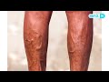 Download Akciğer Embolisi (Pulmoner Emboli) Nedir? Akciğer Embolisi (Pulmoner Emboli) Nedir?