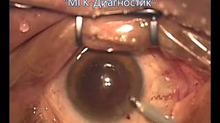 Операция замены хрусталика глаза при катаракте Операция замены хрусталика глаза при катаракте