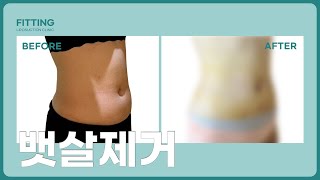 피팅의원 복부 지방흡입 Before &amp; After