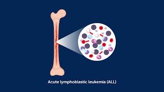 CD19 and CD22Directed Chimeric Antigen Receptor TCell Therapy in Childhood BCell ALL