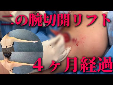 【二の腕脂肪吸引・切開リフト・モフィウス8のダウンタイムのリアル経過】47歳女性のボディの美容施術に密着！？マーキングから施術・ダウンタイム経過を紹介します！