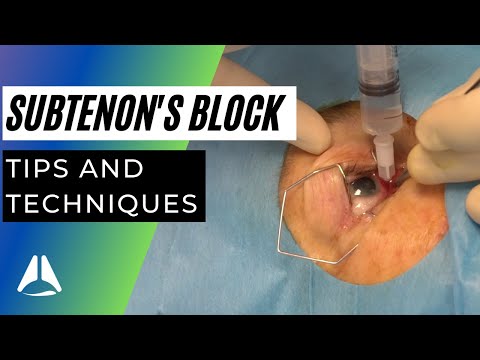 Subtenon&rsquo;s block regional anaesthesia for ophthalmic surgery. Live patient demo!