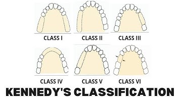Kennedys Classification & Applegate Rule in Removable Partial Denture