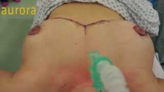 Breast Reduction Surgery, K Cup to a D Cup - Aurora Clinics