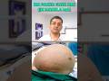 Largest Fibroid Found In A Human Female Fibroid Treatment Without Surgery Dr Gaurav Gangwani Largest Fibroid Found In A Human Female Fibroid Treatment Without Surgery Dr Gaurav Gangwani