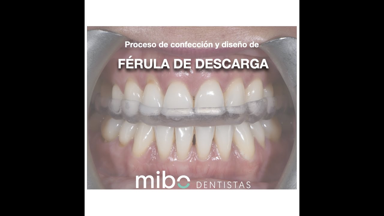 Férula de Descarga para el Bruxismo  Clínica Dental MiBO Almería 