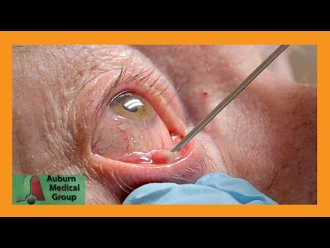 STYE Gets Punctured for Pus Drainage | Auburn Medical Group