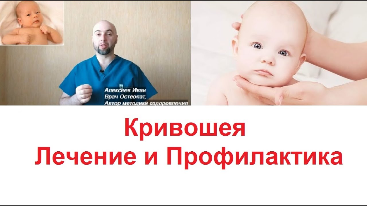 Кривошея у Грудничков Лечение и Профилактика - YouTube