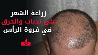 تجربة زراعة الشعر في فروة الرأس عليها ندبة أو أثار حرق في تركيا - مقابلة مع تجربة واقعية ناجحة