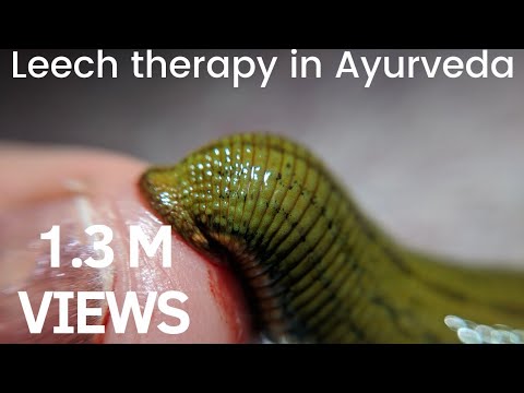 Leech therapy in Ayurveda-Jalauka(जळू) #drpys