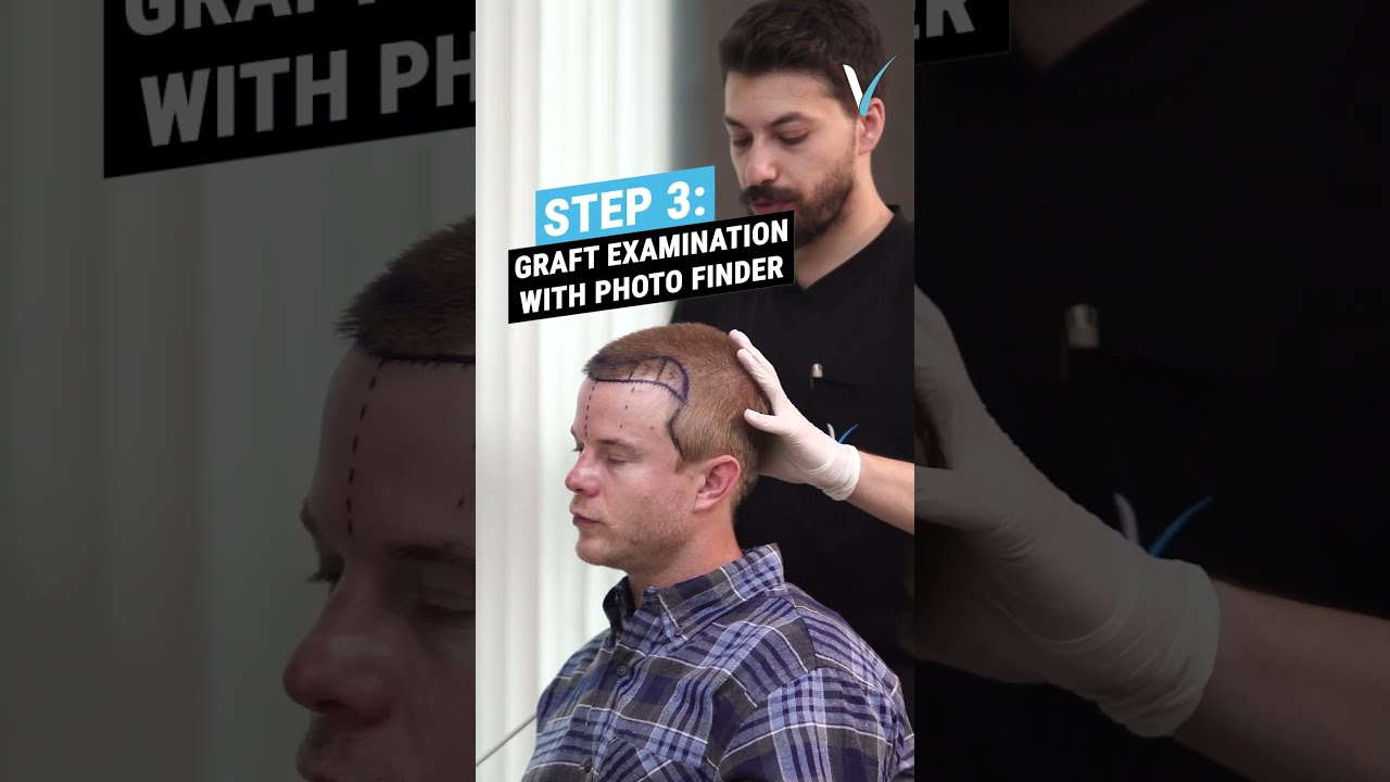 Graham Rogers' Hair Transplant Consultation Turkey 