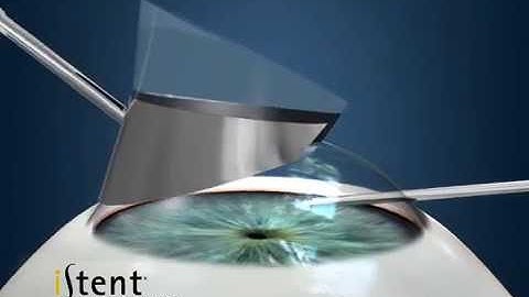 iStent Trabecular Micro-Bypass