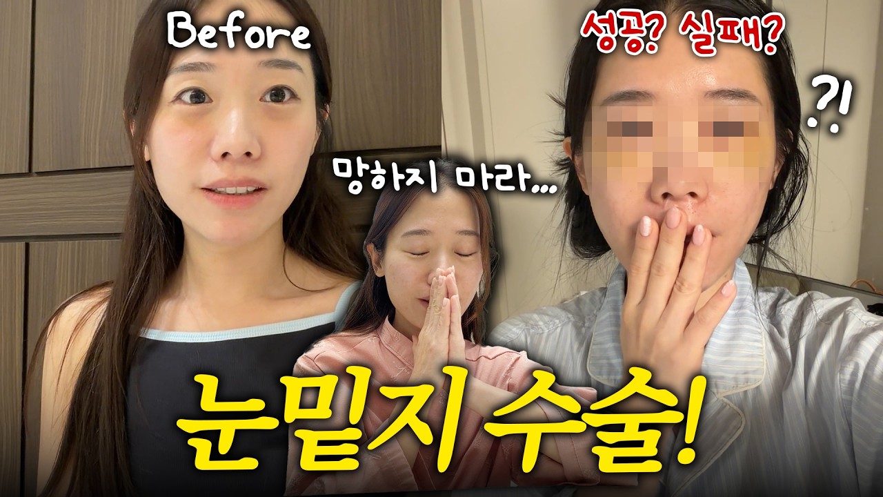 눈밑지방 재배치 당일부터 4일차까지❗️찐 리얼후기, 한국 브이로그!🇰🇷 다이소 신세계⭐️