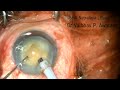 Phaco in Hypermature Cataract , Direct Chop , 26/05/26