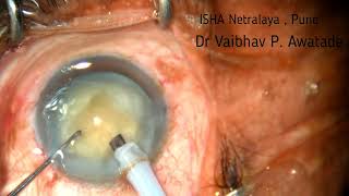 Phaco in Hypermature Cataract , Direct Chop , 26/05/26