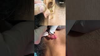 Torn Earlobe? 👂 Ear Lobe Repair Treatment Explained | Skinaa Clinic