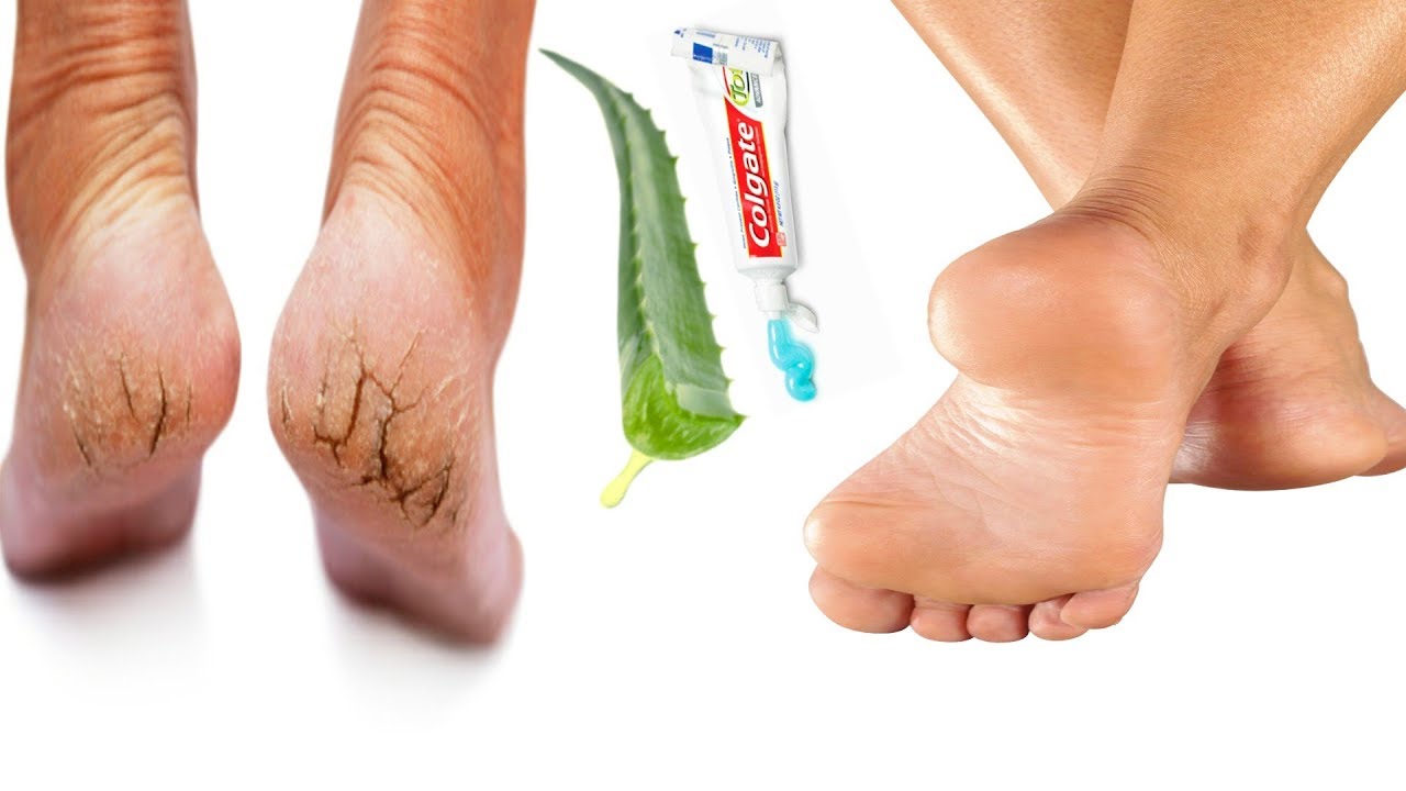 La methode la plus efficace pour avoir les pieds lisse en une nuit