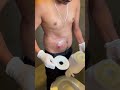 POV: ileostomy Warriors | #shorts
