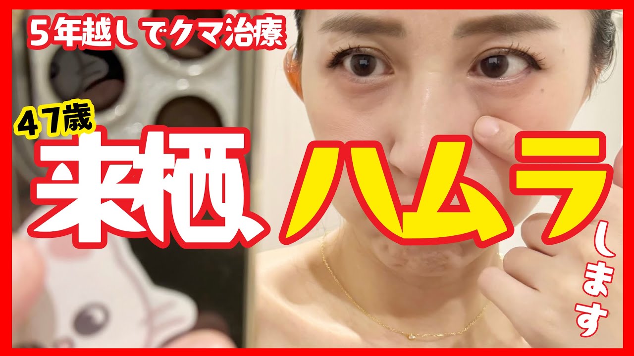 【ダウンタイム経過レポ】5年考えた末・・・「表ハムラ」のリアル【目の下のクマたるみ治療】