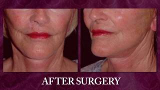 Dimple Creation, Dimpleplasty in Athens, Buckhead, Atlanta and Eatonton Georgia - Meet Dr. Chen