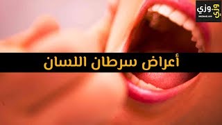 أهم أعراض سرطان اللسان